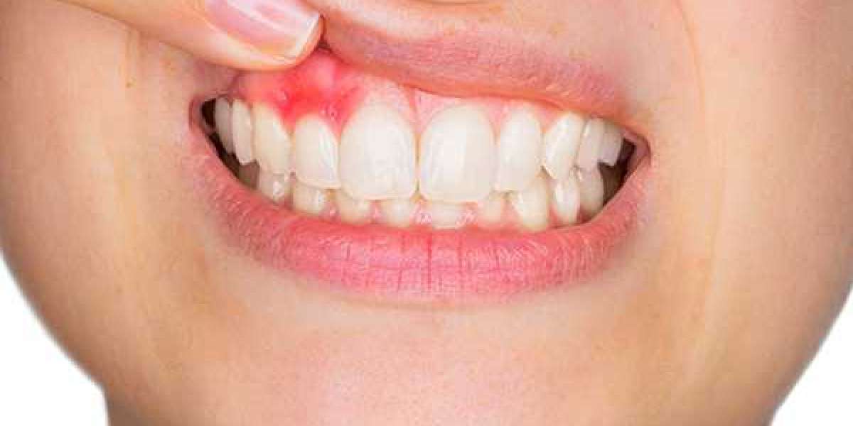 Natural Remedies To Regrow Gums Fast