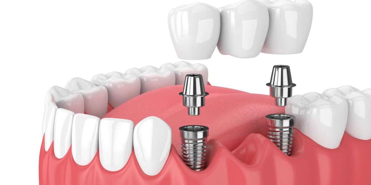 Dental Implants in Christiansted