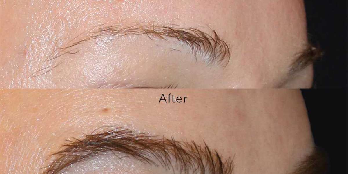 Eyebrow Hair Implants
